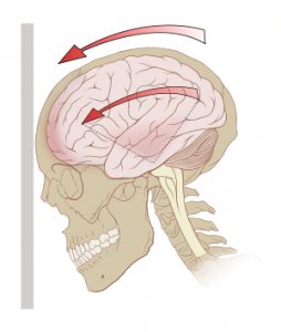 Can a concussion cause chronic headaches and vertigo?